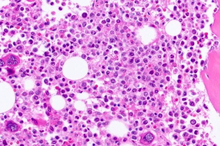 Bệnh di truyền rối loạn Niemann Pick Type C – Alzheimer ở trẻ em?
